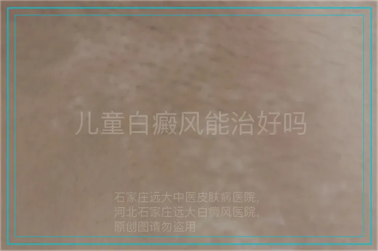 儿童白癜风能治好吗
