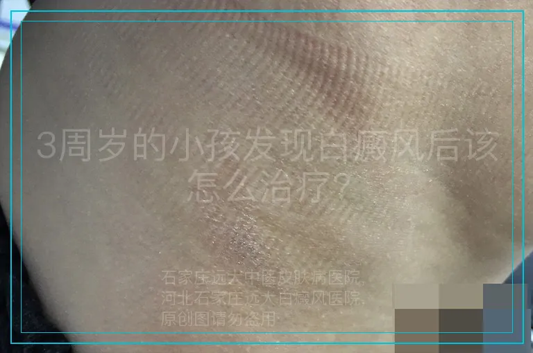 3周岁的小孩发现白癜风后该怎么治疗?