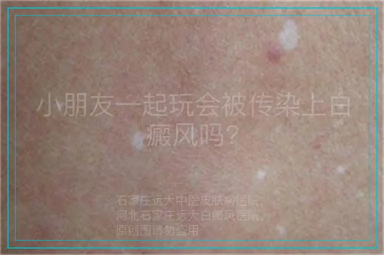 小朋友一起玩会被传染上白癜风吗?