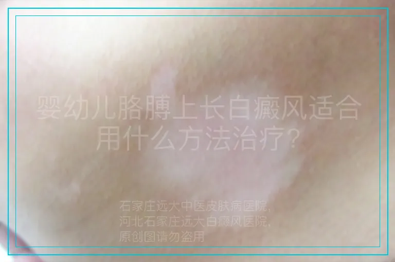 婴幼儿胳膊上长白癜风适合用什么方法治疗?