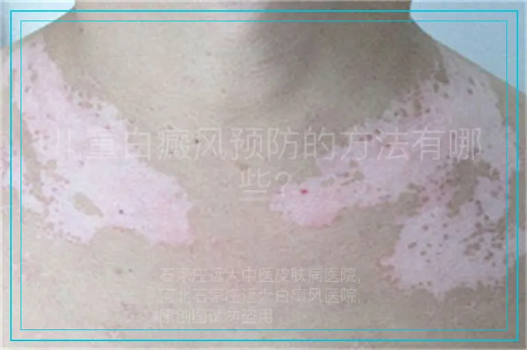 儿童白癜风预防的方法有哪些?