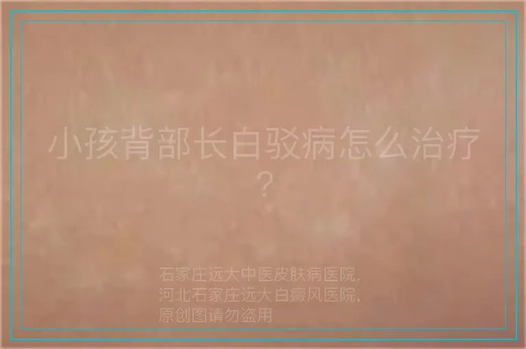 小孩背部长白驳病怎么治疗?