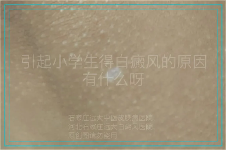 引起小学生得白癜风的原因有什么呀