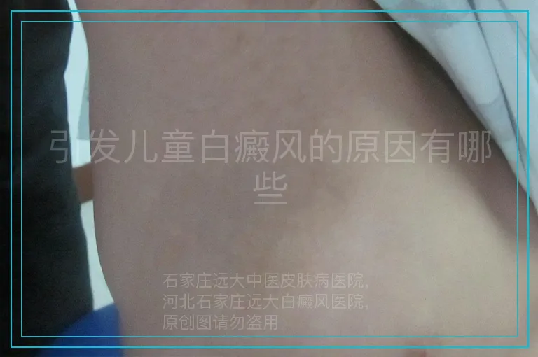 引发儿童白癜风的原因有哪些