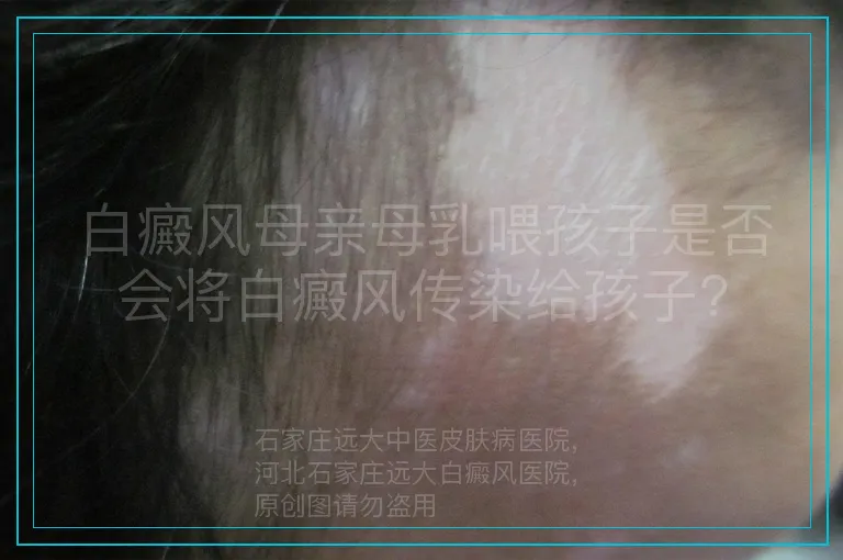 白癜风母亲母乳喂孩子是否会将白癜风传染给孩子?