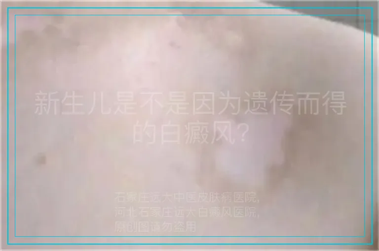 新生儿是不是因为遗传而得的白癜风?