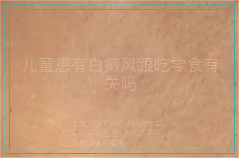 儿童患有白癜风跟吃零食有关吗