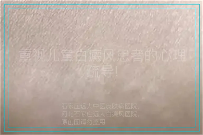 重视儿童白癜风患者的心理疏导!