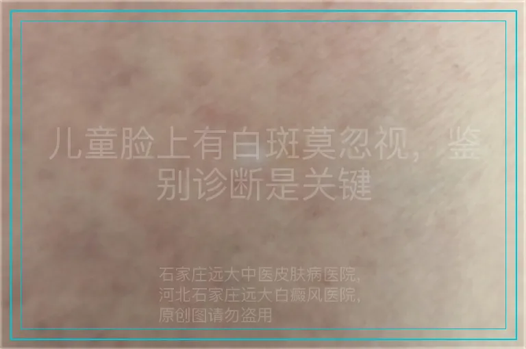 儿童脸上有白斑莫忽视，鉴别诊断是关键