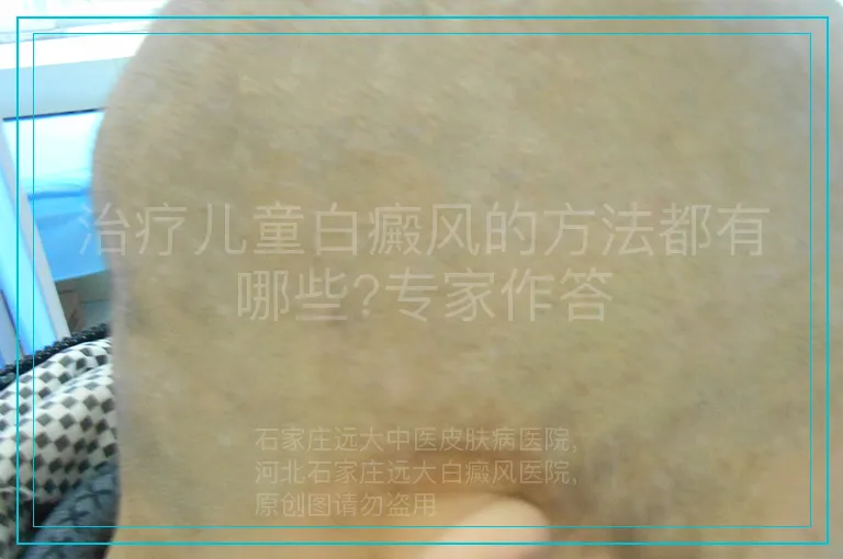 治疗儿童白癜风的方法都有哪些?专家作答