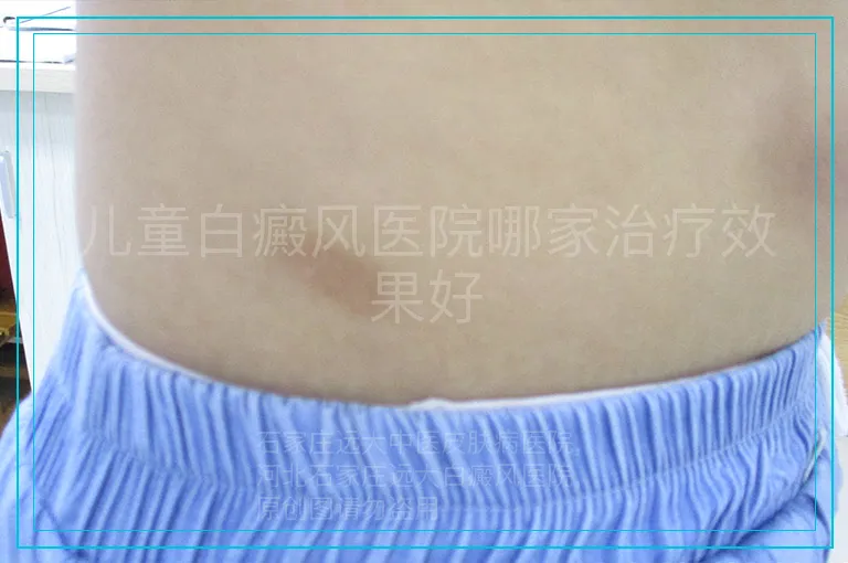 儿童白癜风医院哪家治疗效果好