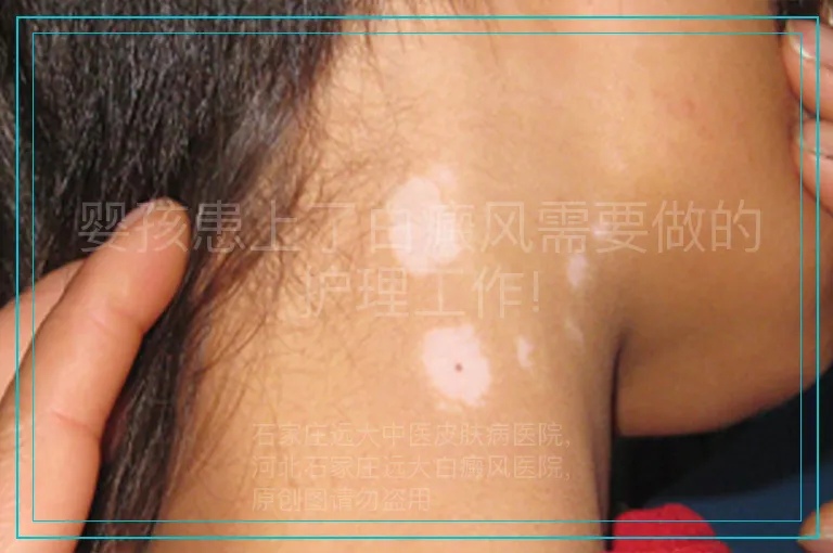 婴孩患上了白癜风需要做的护理工作!