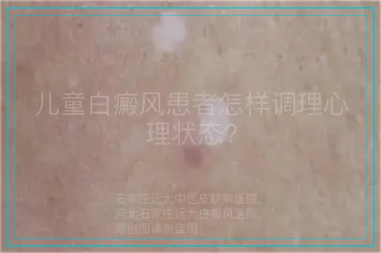 儿童白癜风患者怎样调理心理状态?