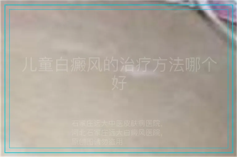 儿童白癜风的治疗方法哪个好