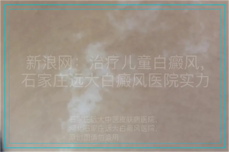 新浪网：治疗儿童白癜风，石家庄远大白癜风医院实力强