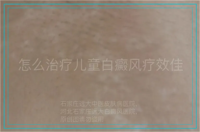怎么治疗儿童白癜风疗效佳