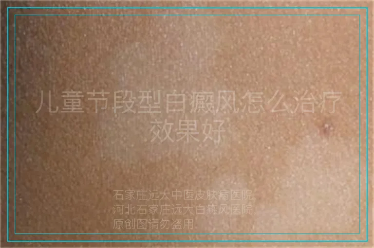 儿童节段型白癜风怎么治疗效果好