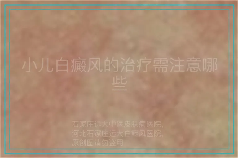 小儿白癜风的治疗需注意哪些