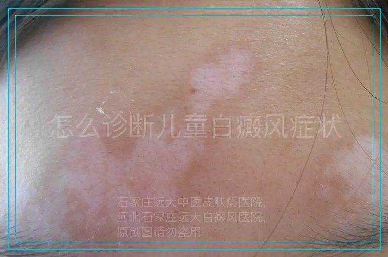怎么诊断儿童白癜风症状