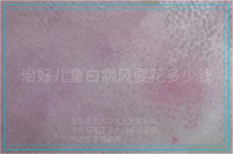 治好儿童白癜风要花多少钱