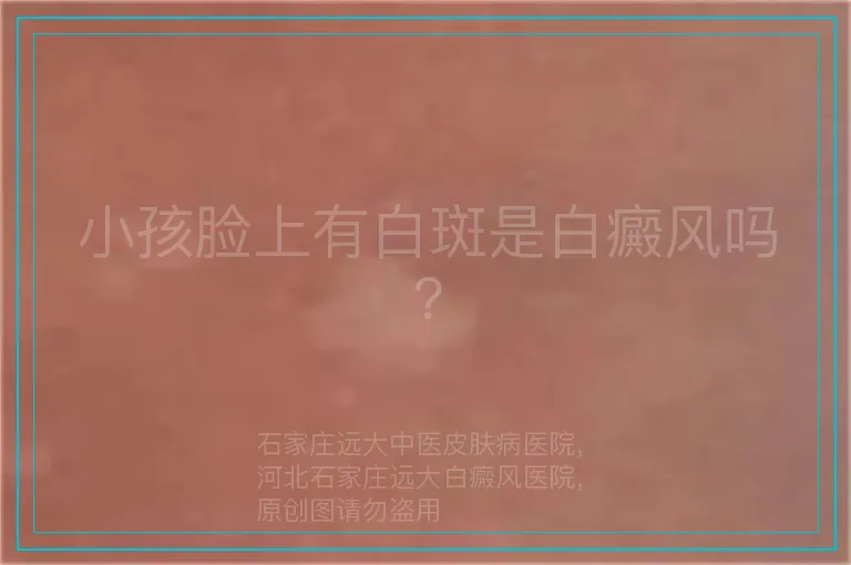 小孩脸上有白斑是白癜风吗?