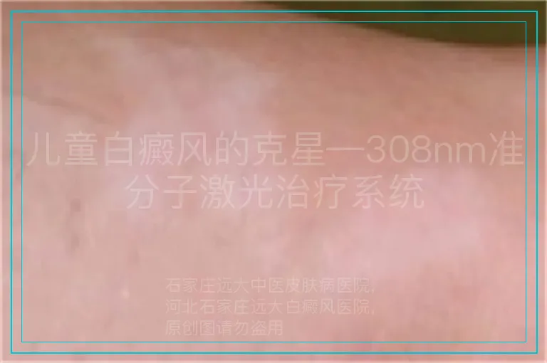儿童白癜风的克星—308nm准分子激光治疗系统