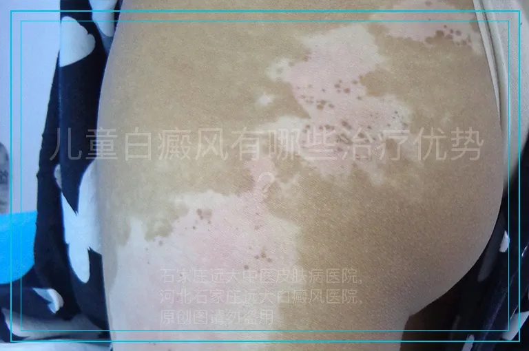 儿童白癜风有哪些治疗优势?