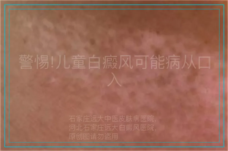 警惕!儿童白癜风可能病从口入