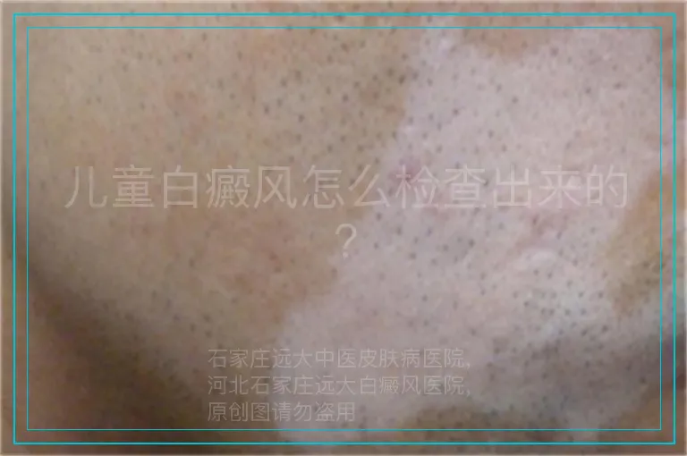 儿童白癜风怎么检查出来的?