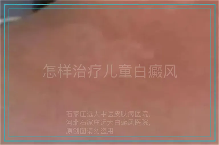 怎样治疗儿童白癜风