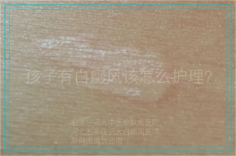 孩子有白癜风该怎么护理?