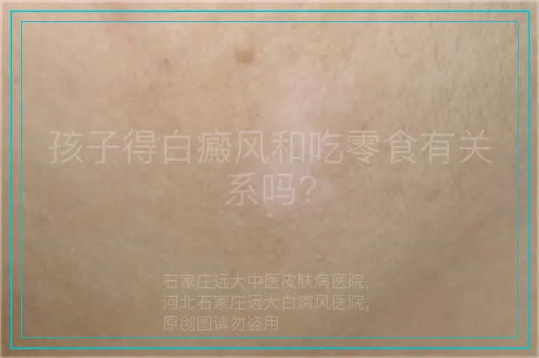 孩子得白癜风和吃零食有关系吗?