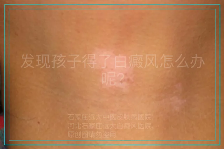 发现孩子得了白癜风怎么办呢?