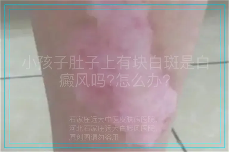 小孩子肚子上有块白斑是白癜风吗?怎么办?