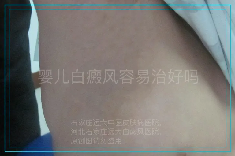 婴儿白癜风容易治好吗