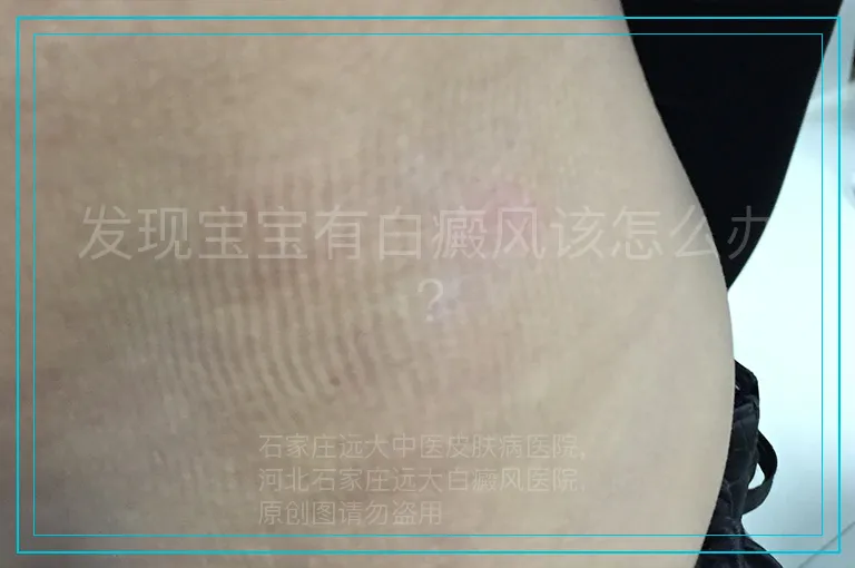 发现宝宝有白癜风该怎么办?