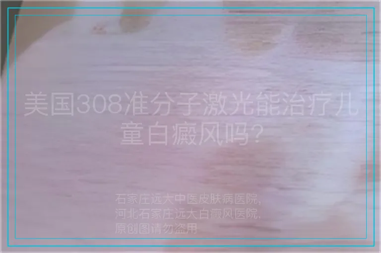 美国308准分子激光能治疗儿童白癜风吗?
