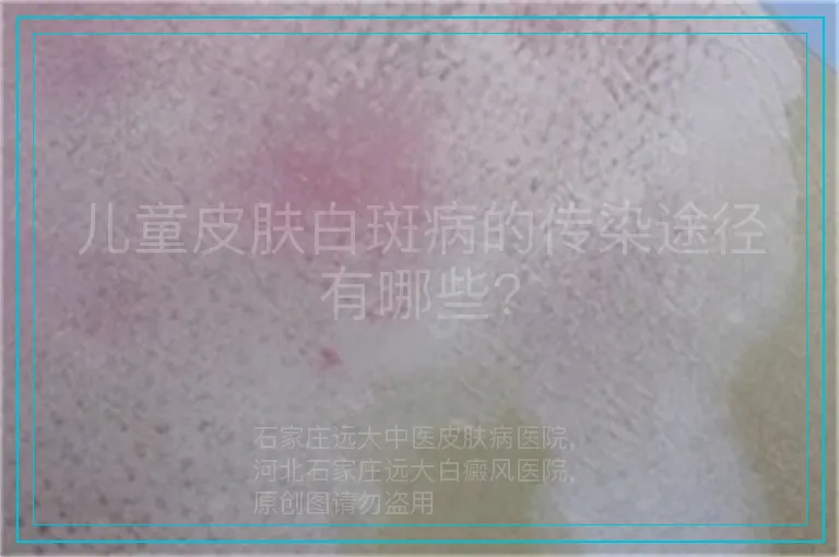 儿童皮肤白斑病的传染途径有哪些?