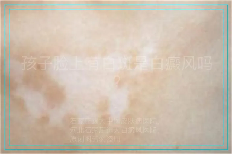 孩子脸上有白斑是白癜风吗?