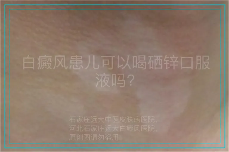 白癜风患儿可以喝硒锌口服液吗?