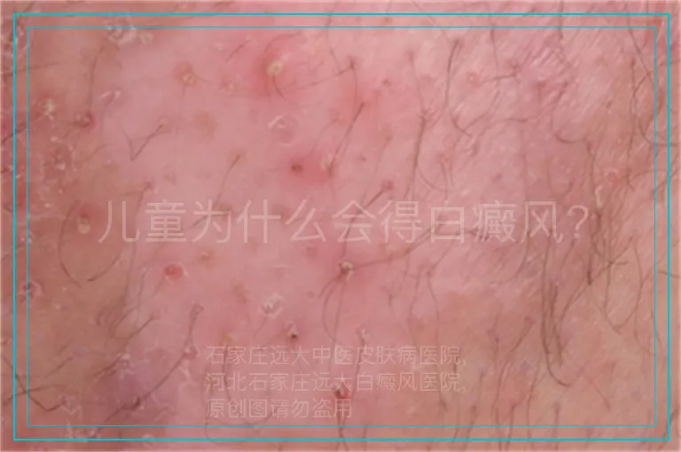 儿童为什么会得白癜风?