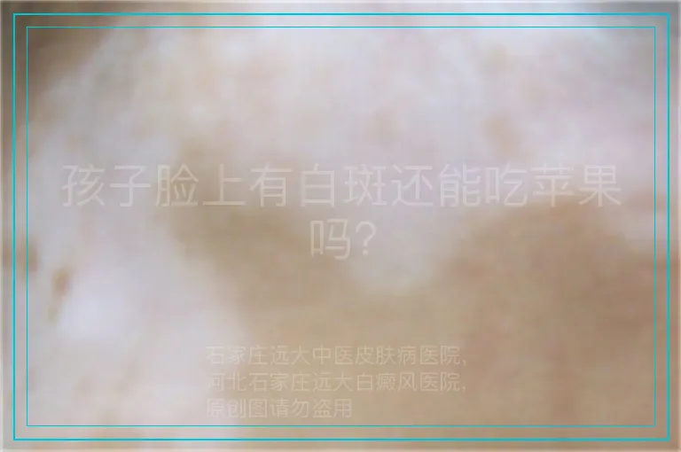 孩子脸上有白斑还能吃苹果吗？