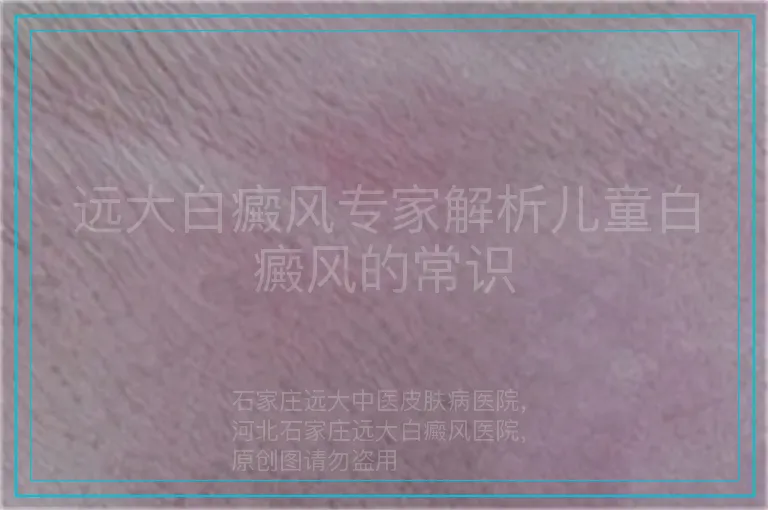 远大白癜风专家解析儿童白癜风的常识