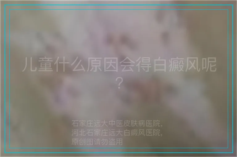 儿童什么原因会得白癜风呢?