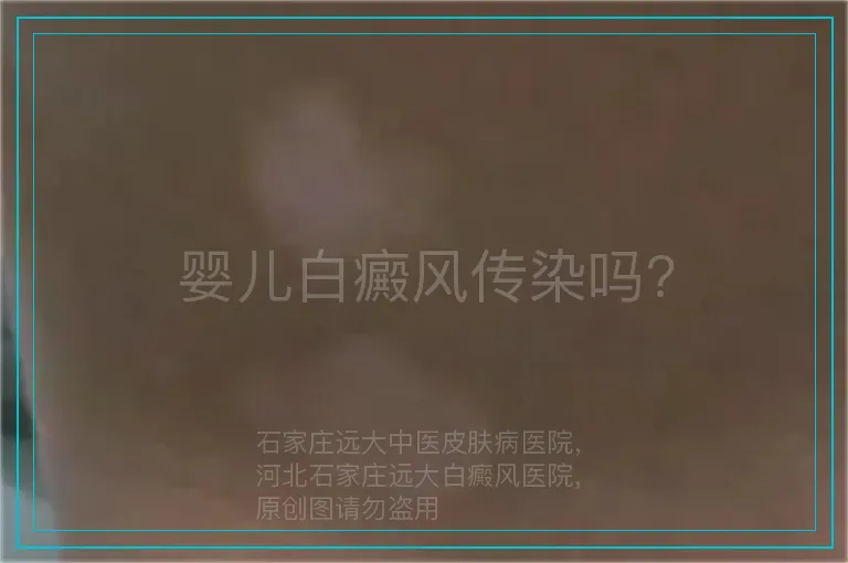 婴儿白癜风传染吗?