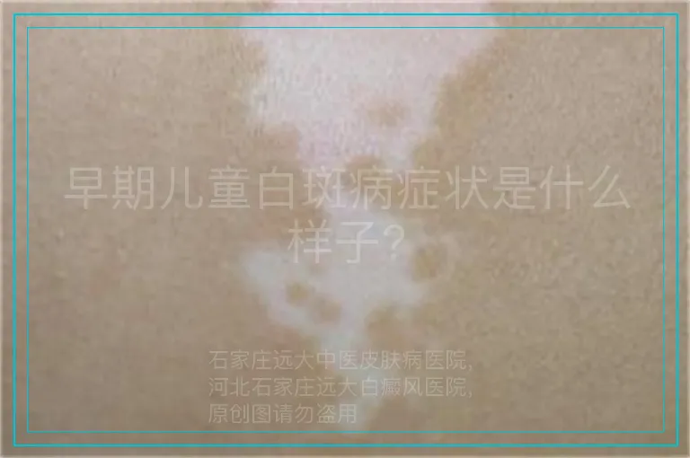 早期儿童白斑病症状是什么样子?
