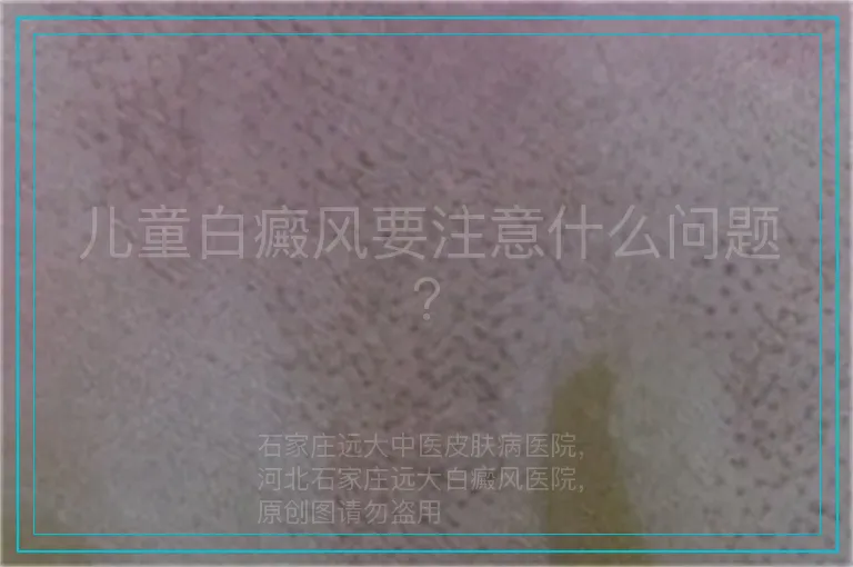 儿童白癜风要注意什么问题？