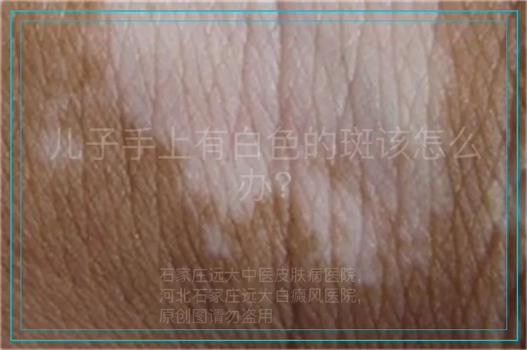 儿子手上有白色的斑该怎么办?