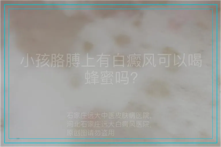 小孩胳膊上有白癜风可以喝蜂蜜吗?