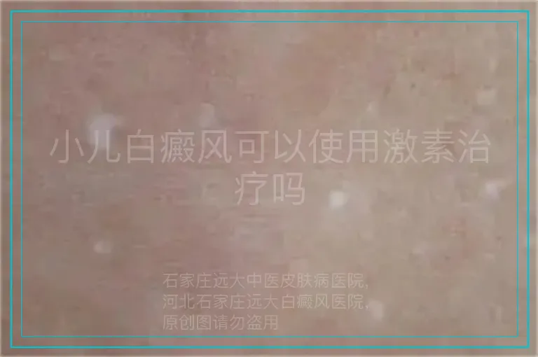 小儿白癜风可以使用激素治疗吗
